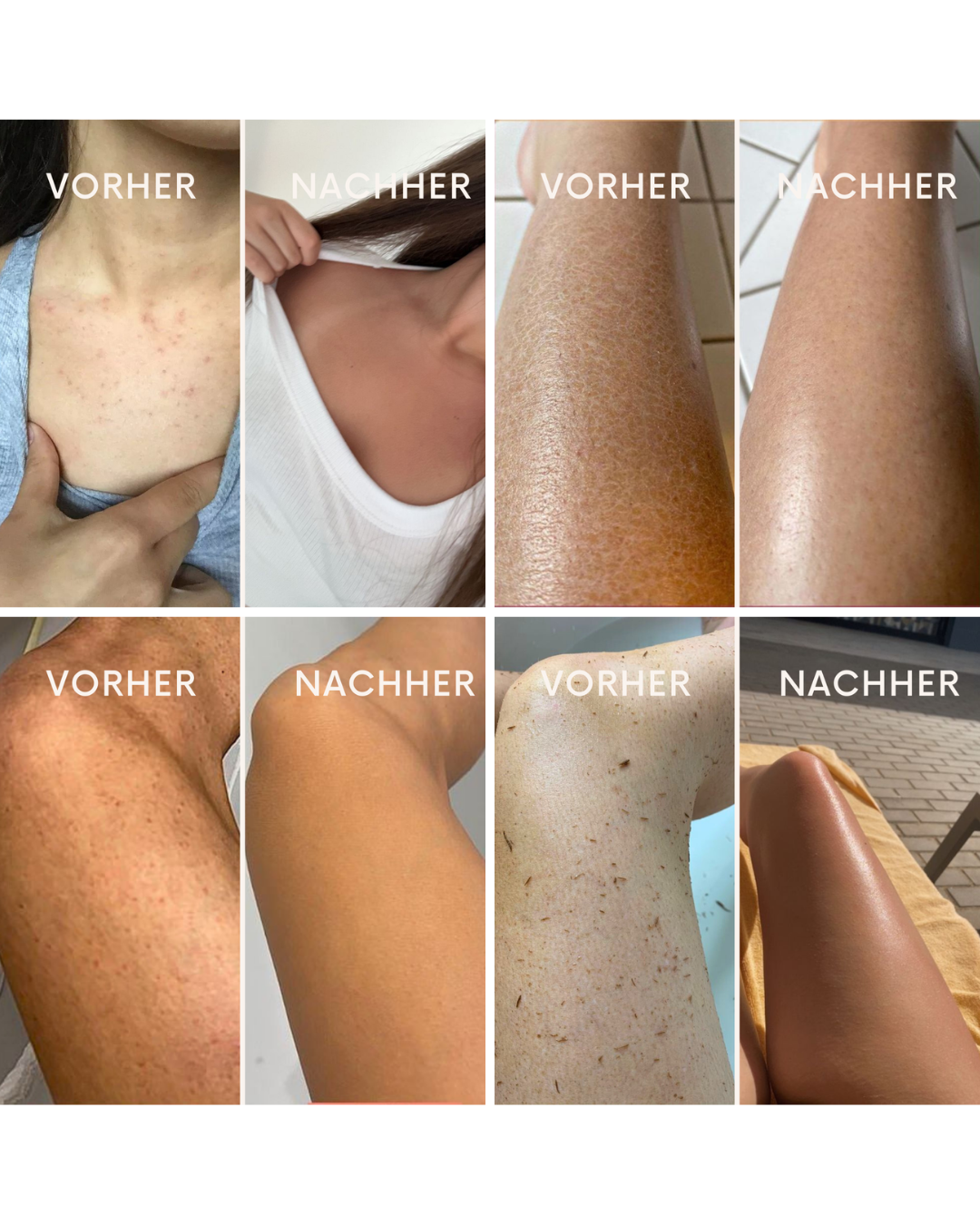 Vorher-Nachher Effekt mit Bodypeeling– glattere Haut sichtbar
